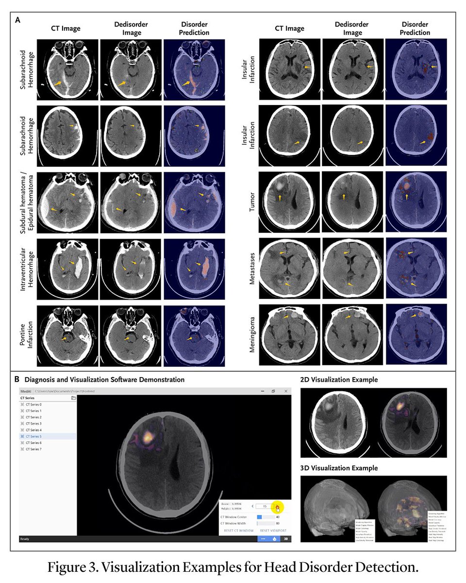 A novel AI–based system provides accurate and generalizable broad-spectrum disorder detection in medical imaging. Read the Original Article by Yuwei He, PhD, et al.: nejm.ai/4aCdTfC