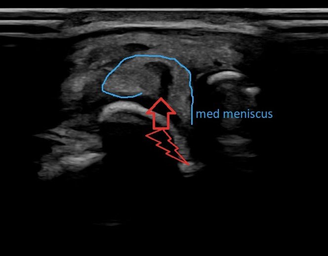 Medial meniscus with protrusion and tear in #mskus #pocus #pocushub #GElogiqE10r3 - additional #arthrosis with #osteophyts is also visible