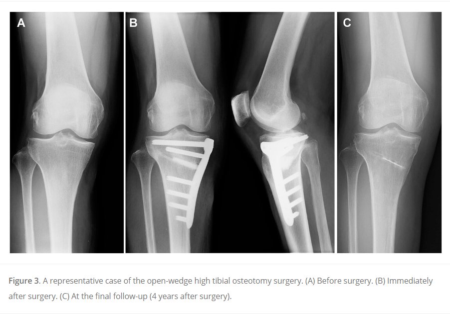 Does age affect outcomes after high tibial osteotomy? This Japanese cohort study of 344 knees showed no difference in radiologic outcomes or PROs. #HTO #kneearthritis #TKA #OrthoTwitter Discover the details #OpenAccess here! ow.ly/Ixaq50RaQJG