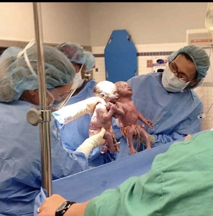 Instead of giving birth naturally, they had to have a caesarean section because the sister held her brother's hand tightly. The birth took place in Orville, Ohio, USA.