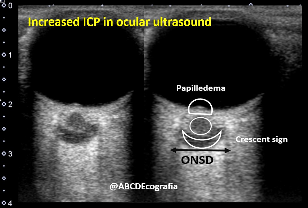 Increased ICP in ocular ultrasound