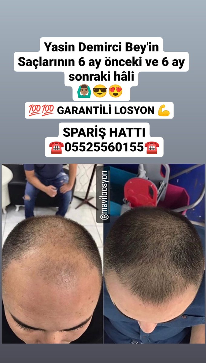 HAYIRLI SABAHLAR 🤲 💯💯 GARANTİLİ SAÇ ÇIKARTAN SERUM 😎 👉 MUTLAKA DENEYİN ✅SAÇI DÖKÜLMESİNE SON ❌ ✅ SAÇLARINIZ YENİDEN ÇIKSIN 👍 👉 DÜNYANIN HER YERİNE KARGO🌍 👇SPARİŞ İÇİN 👇 ☎️05525560155☎️ #ADSvGS #HaddiniBilKübraPar