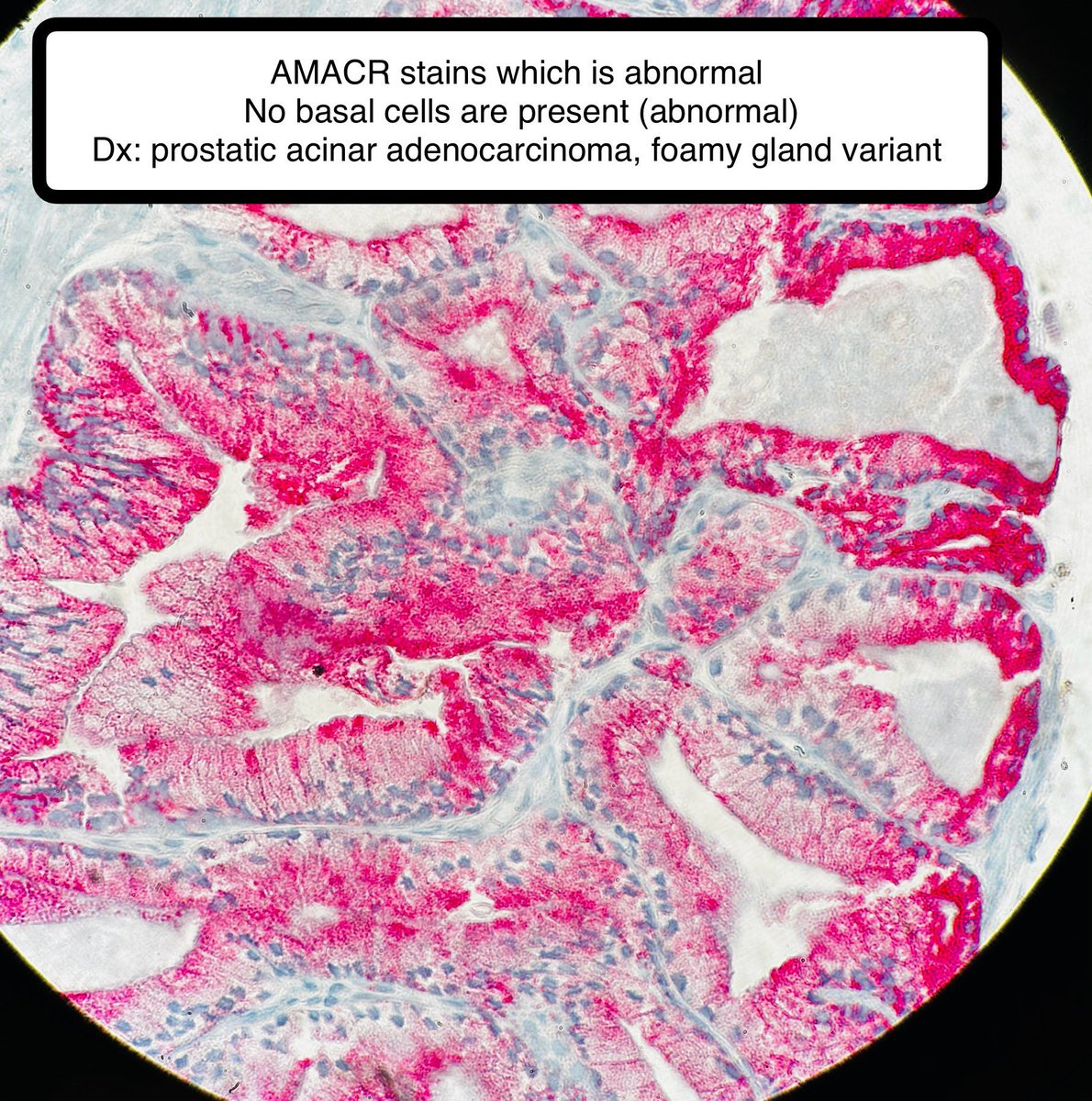 Mucinous Metaplasia of Prostate • Benign, although can look crowded at times and can have luminal mucin extravasation • DDX includes: — “Foamy Gland” Adenocarcinoma (larger glands, infiltrative, may have eosinophilic secretion) Credit: Dr. Daniel Hagen #pathagonia #pathx