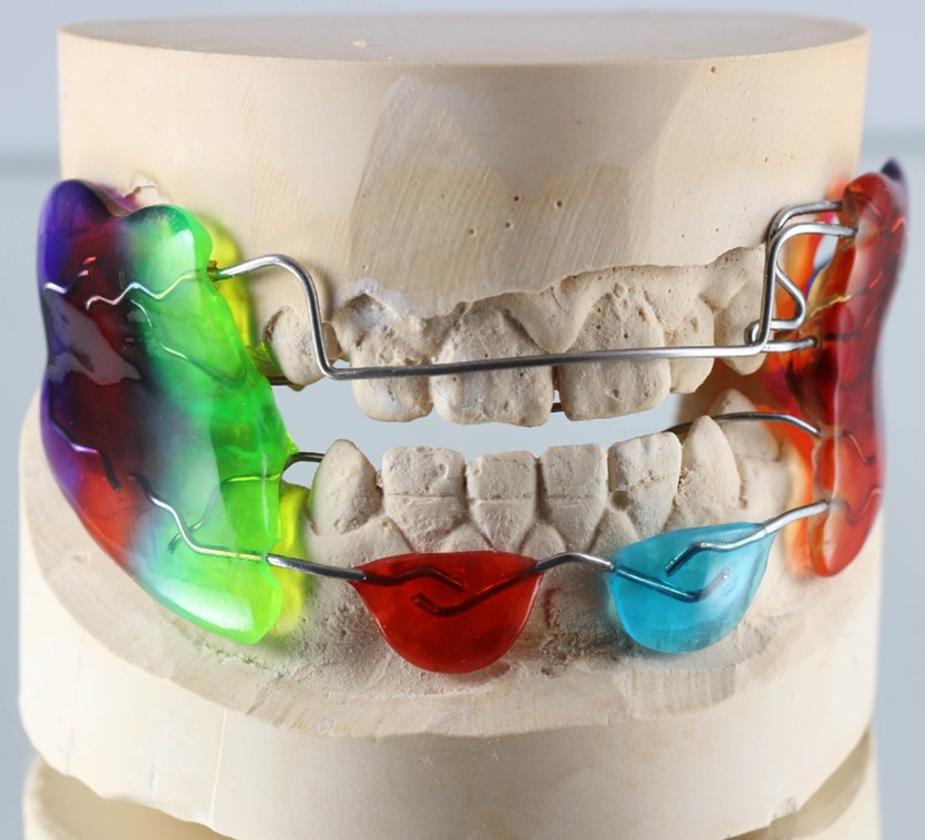 The Frankel Orthodontic Appliance is specifically engineered to guide the natural growth processes of the jaw & facial structure, encouraging them to develop in a more aligned manner.

#flossdental #thetoothdr #flossboss #ivanovortho #frankelortho #fulldent #trinidadandtobago