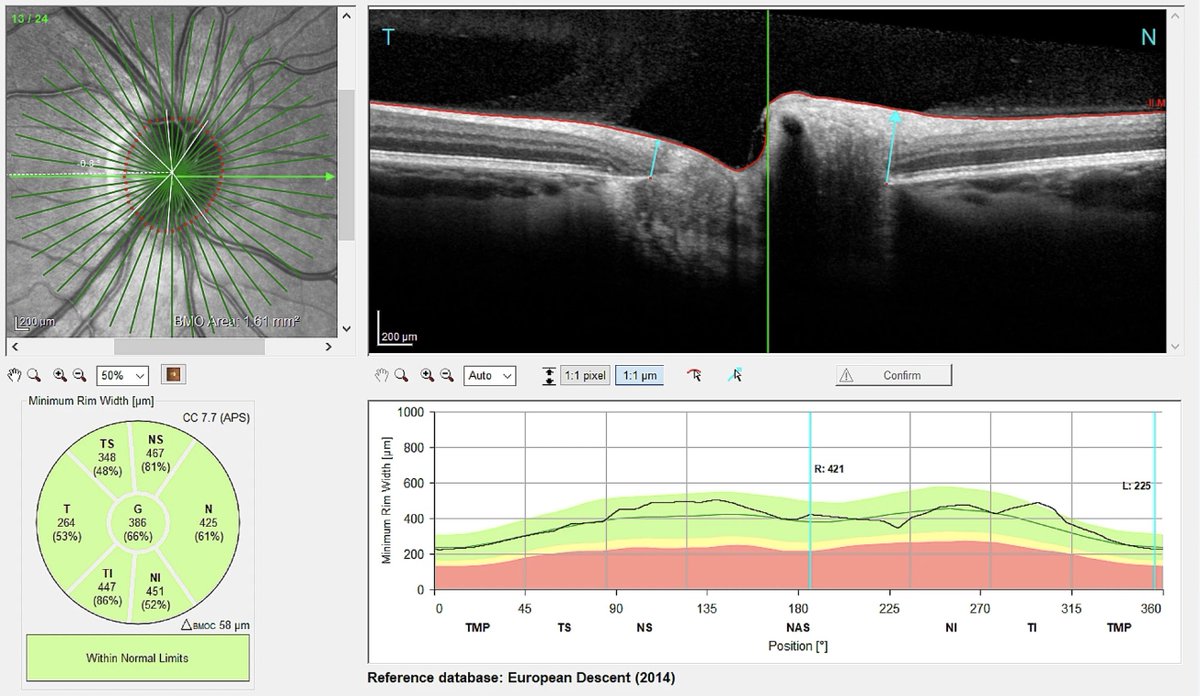 Check MRW Measurements over RNFL for Damage from Anti-VEGF Injections

The former is a more sensitive marker for evaluating the effect of frequent injections on the optic nerve head.
reviewofoptometry.com/article/check-…
#optometry #glaucoma #retina #antivegf