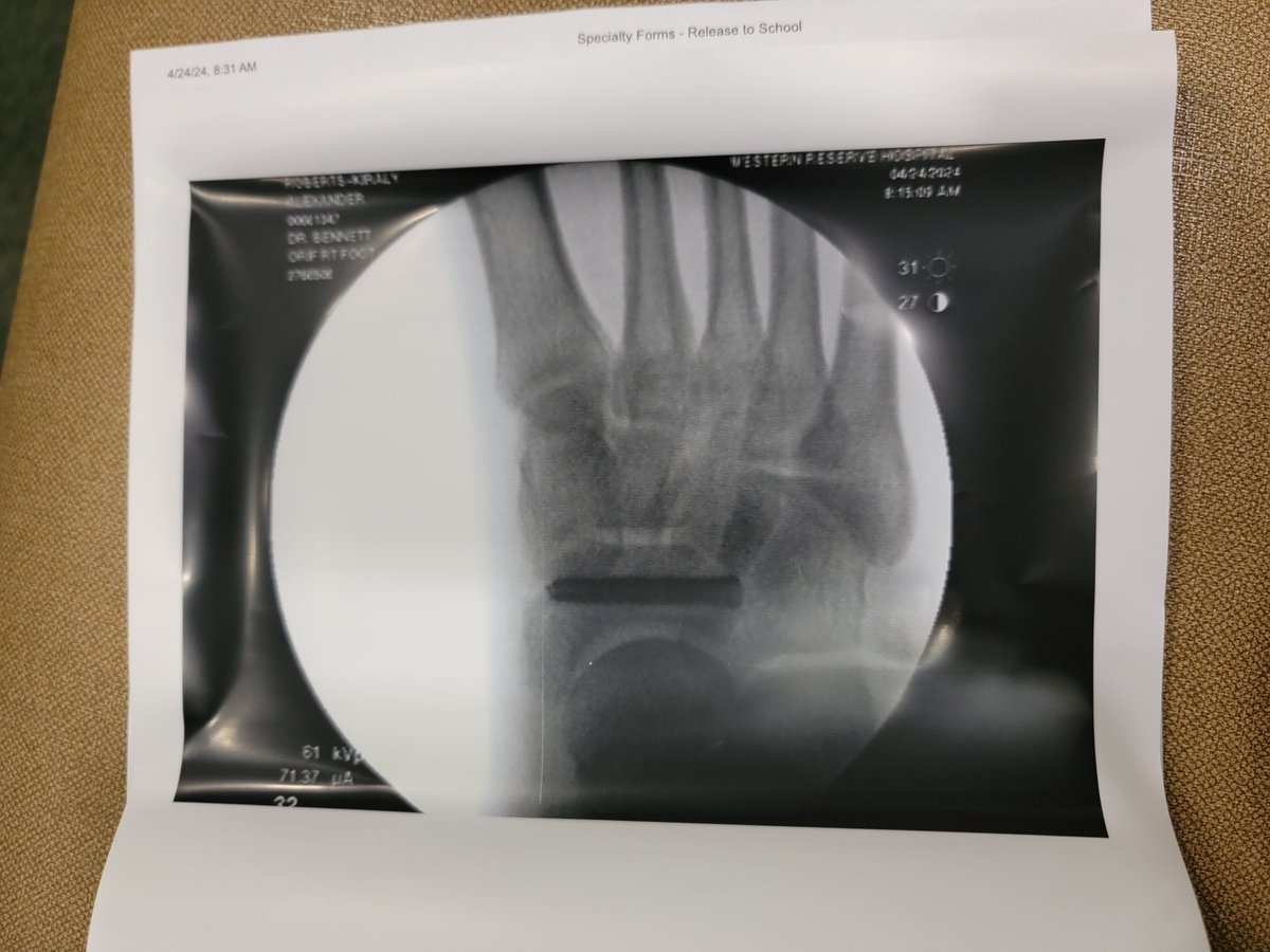 Definitely not how I pictured senior year track season to go.  Fractured my navicular bone running the very first race of the spring season after a long battle with tendonitis.  Will be focusing on recovery &amp; looking forward to coming back stronger than ever.