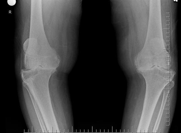 LUTUTmu

Dipake lama bakal rusak.
Tapi banyak juga yang belum lama tapi uda rusak/kerusakan lutut dini/osteoarthritis, jika :
1. Obesitas
2. Riwayat cedera lutut yg tidak ditangani dgn baik
3. Adanya radang sendi yg dibiarkan(asam urat,infeksi,dsb)
4. Aktivitas berat, otot lemah