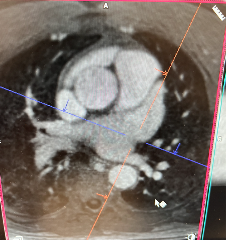 Don't forget #whyCMR @SCMRorg for #LAA rule out. #whyCMR ordered for another indication followed by #echofirst TEE for LAA ruleout. No need of course! 3D heart MRA added and TEE canceled @onco_cardiology @purviparwani @DrRyanPDaly @tiffchenMD