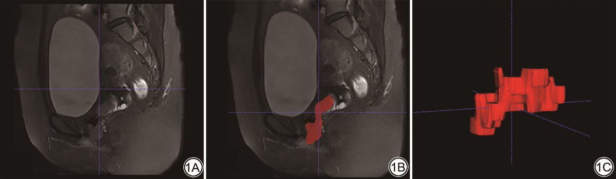 The combination of #DTL features from #MR-T2WI, #radiomics features, and clinical characteristics can effectively predict #LVSI in cervical cancer.
med-sci.cn/cgzcx/article/…