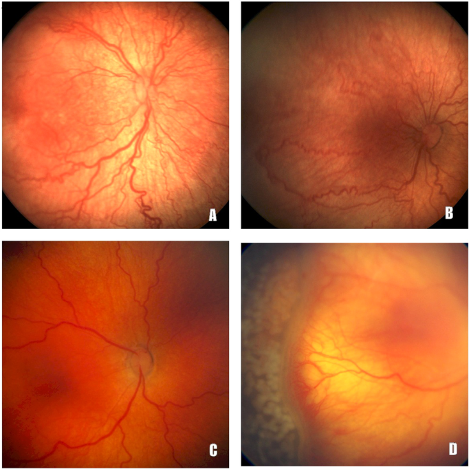 Ophthopedia Update: The Royal College of Paediatrics and Child Health Retinopathy of Prematurity Screening Guidelines (2022): a series of treated infants falling outside the updated criteria dlvr.it/T5zLMK #Ophthalmology #Eye #Ophthotwitter