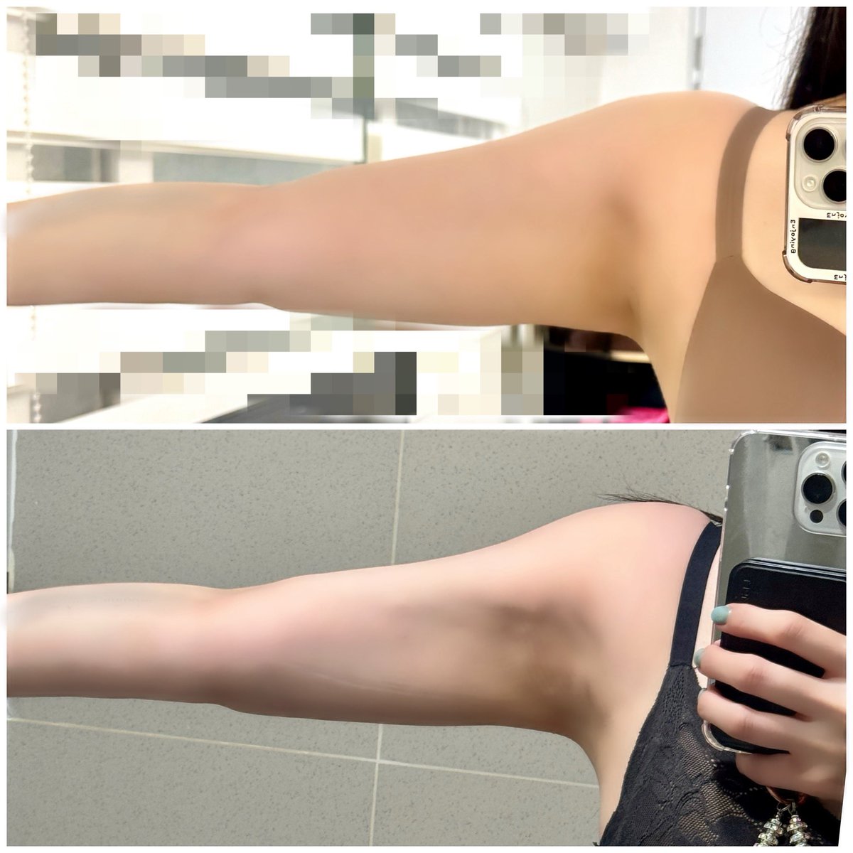 After 6 weeks from arm liposuction surgery!! My arms have gotten 5cm thinner than before!!! I still feel little bit pain but I’m very happy and satisfied with this result♥️♥️
