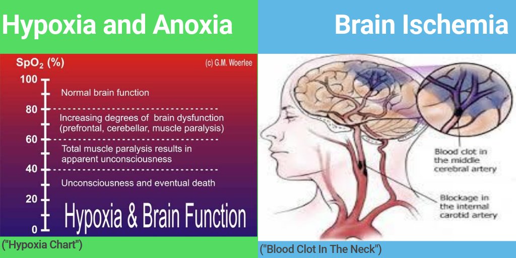 @MdBreathe The main cause of seizures is Cerebral Hypoxia.