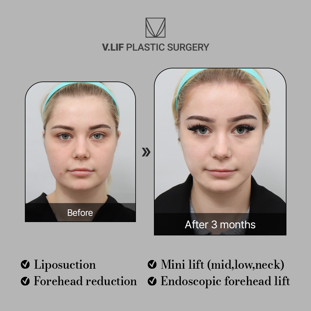 💙FACELIFT SPECIALISTS IN KOREA!💙#vlif

#facelift #necklift #liposuction #minilifting #aestheticsurgery #browlift #facialplasticsurgery #antiwrinkle #looseskin #plasticsurgery #forehead #DOUBLECHIN #smilelines #skintightening #boardcertifiedplasticsurgeon #vlifplasticsurgery