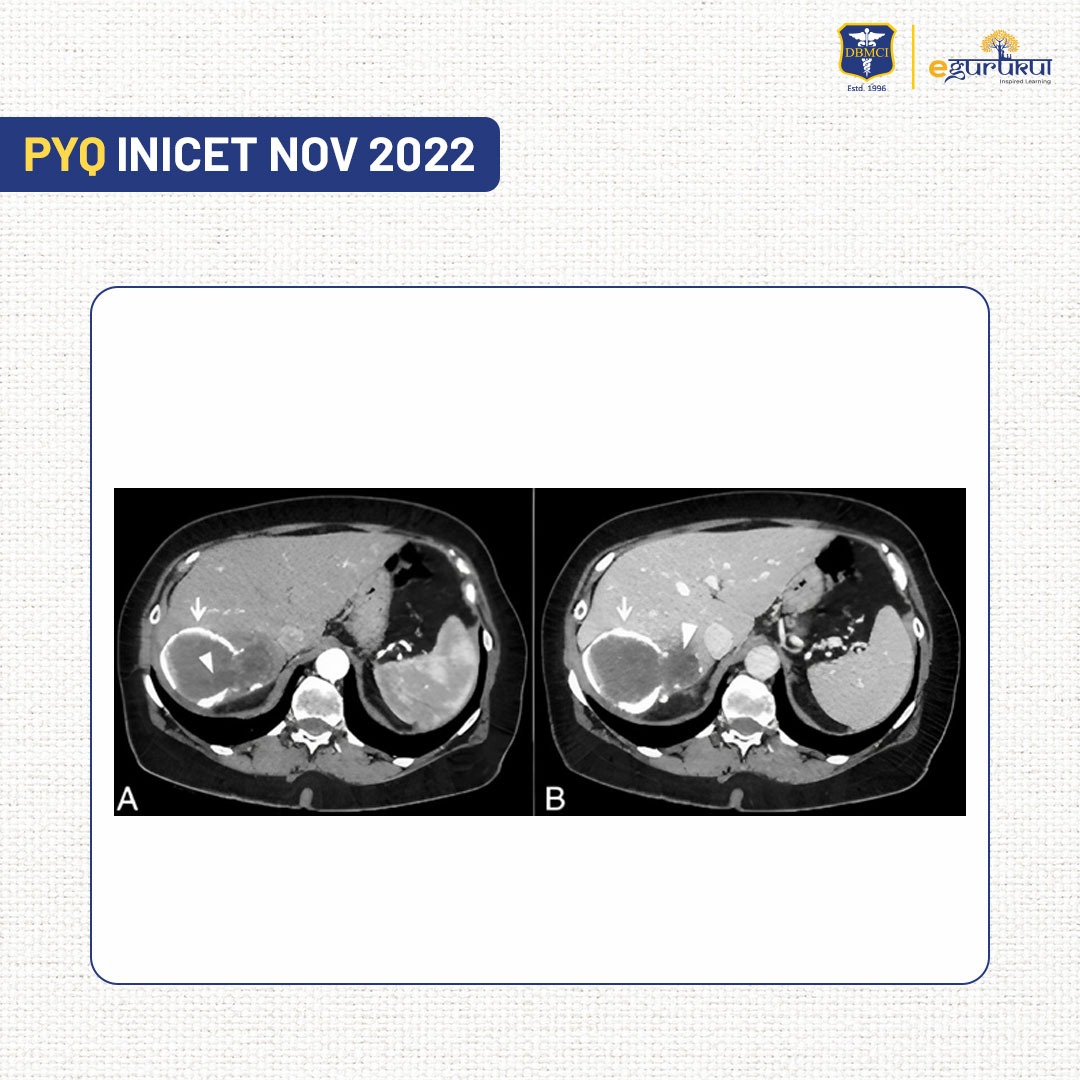 dbmci_official's tweet photo. #inicet_pyq
Q. Identify the focal lesion on the CT abdomen: (Surgery)
A. Focal nodular hyperplasia
B. Hydatid cyst
C. Liver Abscess
D. Hepatocellular carcinoma

#Moderate #SURGERY #GIT #Liver #Factual #NEET #INICET #IBQ #INICETMay2024 #INICETPYQ #IBQoftheDay #neetpg https://t.co/gRmT4M0xSm