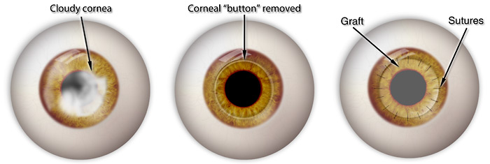 This is a penetrating keratoplasty, where the recipient cornea is being removed after trephination.

This is an open sky technique. 

#MedTwitter #MedEd #ophthalmology #cornea
Image from google