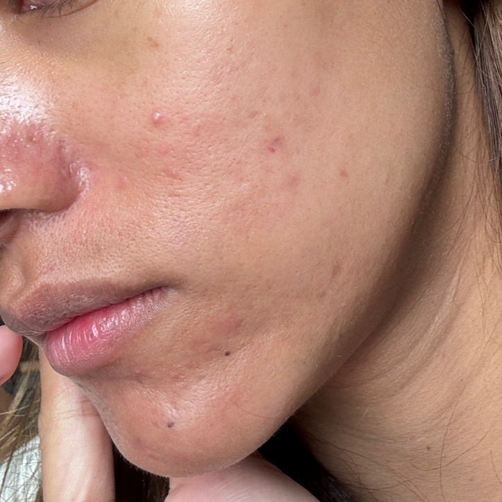 unabegirl's tweet photo. La Roche-Posay ขอรีวิวเรียบๆเลย ช่วงก่อนเป็นสิว ผิวแห้ง ขรุขระไปหมด แต่งหน้าไม่ติดเลย เครียดมาก 

เลยตัดสินใจลองซื้อ Effaclar DUO+M มาใช้ เค้าเป็นสูตรใหม่ ที่จัดการสิว แบลคทีเรีย C.Acnes ได้ดี 

ใช้ไปใช้มาสรุปสิวลดลง สิวแห้งลงเยอะมากกกกก สิวอักเสบ สิวผด ดีขึ้น ใช้สูตรนี้จรงจุดมาก แนะนำเลย 
มีขายที่ watsons eveandboy นะ

#LaRochePosayTH