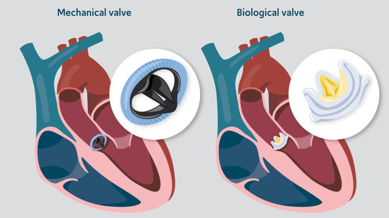 📢 New #reviewpaper/#article Published Online
🙌“RESEARCH TOPIC” Artificial Heart Valve
🕝 Deadline: 2024.July 30th
🔎 Link: journal.hsforum.com/index.php/HSF/…
#HeartSurgery #HeartValve