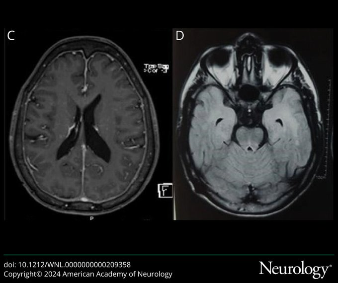 Test your clinical reasoning with this case of a 24-year-old man with gait impairment, hearing loss, and recurrent fever: #NeurologyRF #NeuroTwitter
bit.ly/4d2ewAW