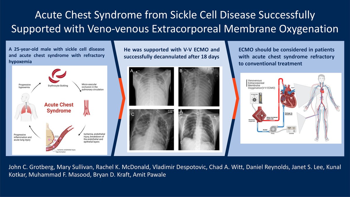 #AcuteChestSyndrome from #SickleCell disease successfully supported with #VVECMO
👉tinyurl.com/yrnvudwt
@WUSTLmed @Jgrottymd @AmitPawaleMD #ARDS