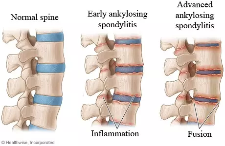 I keep forgetting that it's AS Awareness Month. And I've been diagnosed since 2018.

So here's some awareness for all y'all. Time to get educated because I didn't even know this thing existed until I was diagnosed.
#ankylosingspondylitis #ankylosingspondylitisawareness