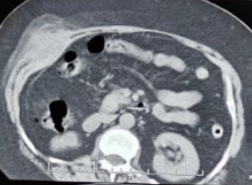 Recurrent abdominal wall abscess. Treated in the past laparoscopically. What should be the work up? #GITwitter