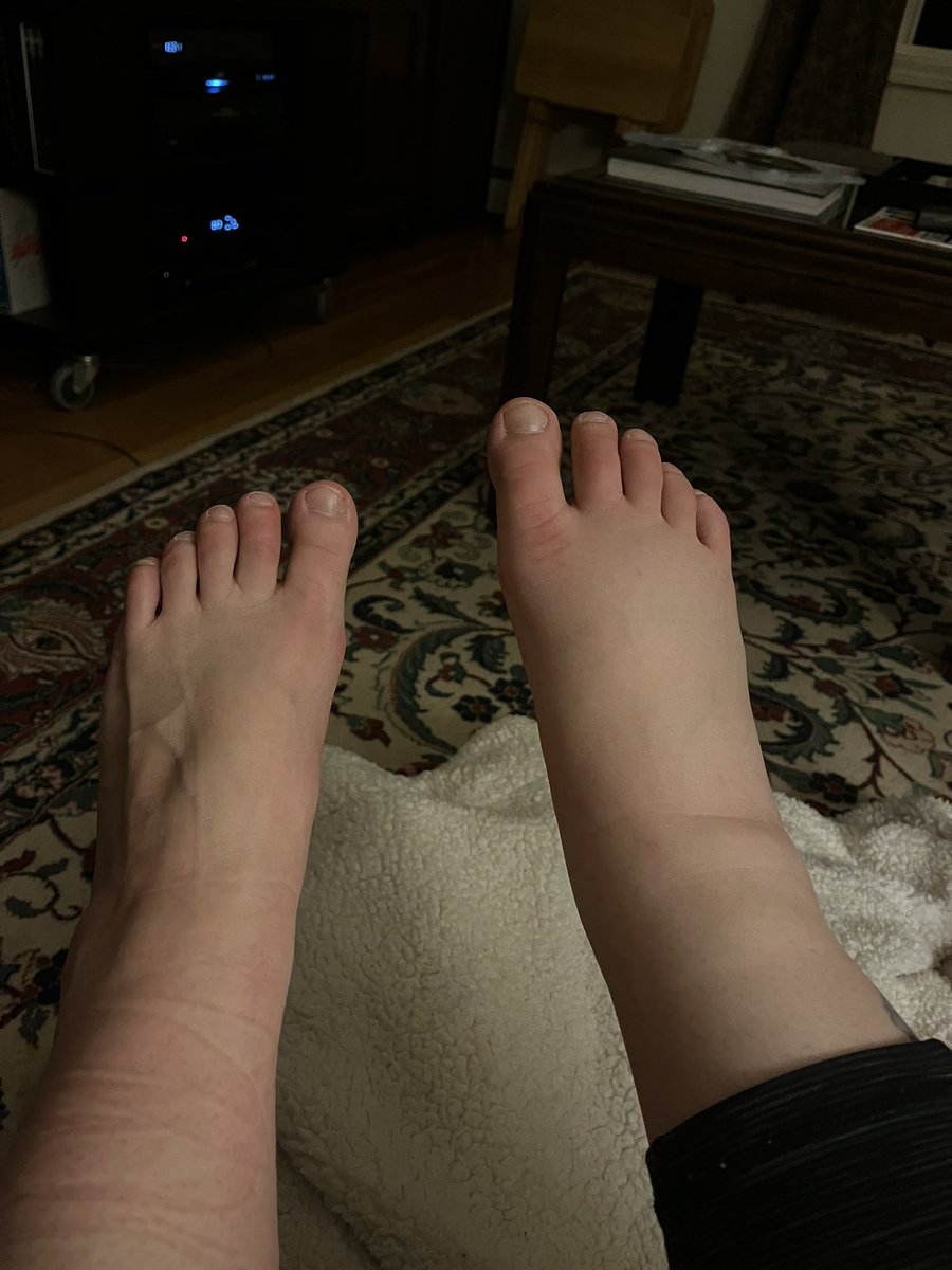 So THIS is a super-fun thing to come out of the blue. My entire right leg is swollen, but my knee to toes are the worst. Took me about 10 minutes to walk upstairs. I hope all of you are having happy, healthy nights.