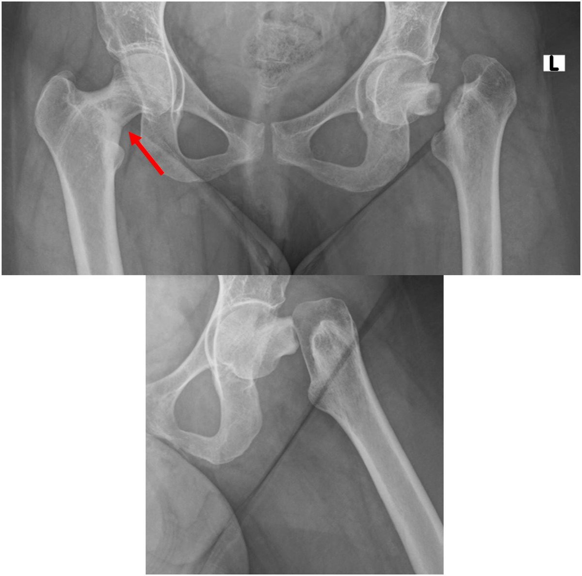 Unusual Presentation of Hip Pain in a Pregnant Woman Due to Bilateral Cervical Neck Stress Fractures #trauma #hip bit.ly/49IIerS