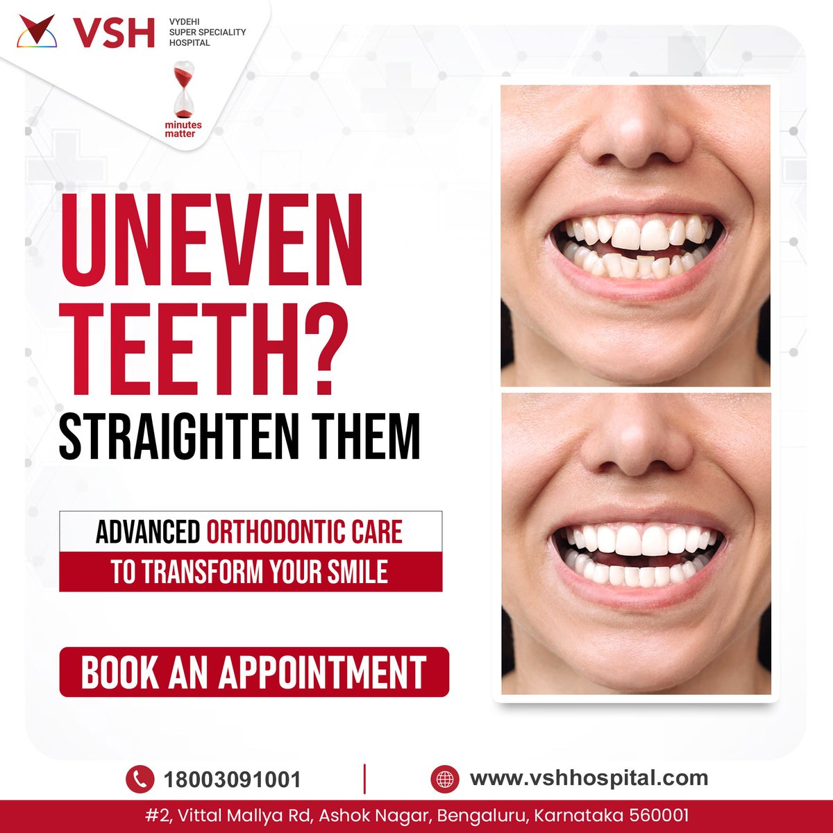 Uneven Teeth Got You Down? Get a confident smile with VSH Hospital's advanced #OrthodonticTreatment!  We offer traditional #Braces & #InvisibleBraces to straighten your teeth discreetly. #AlignYourTeeth & achieve lasting results! #UnevenTeeth #OrthodonticTreatment