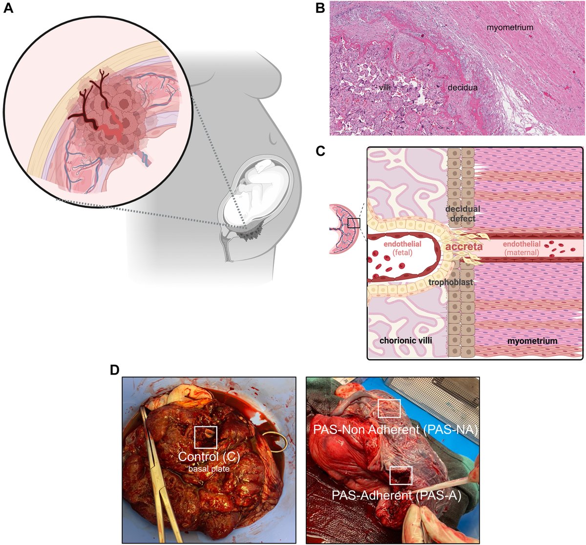 Placenta accreta spectrum disorder at single-cell resolution: a loss of boundary limits in the decidua and endothelium - Study design ow.ly/Hbbj50RgTxY