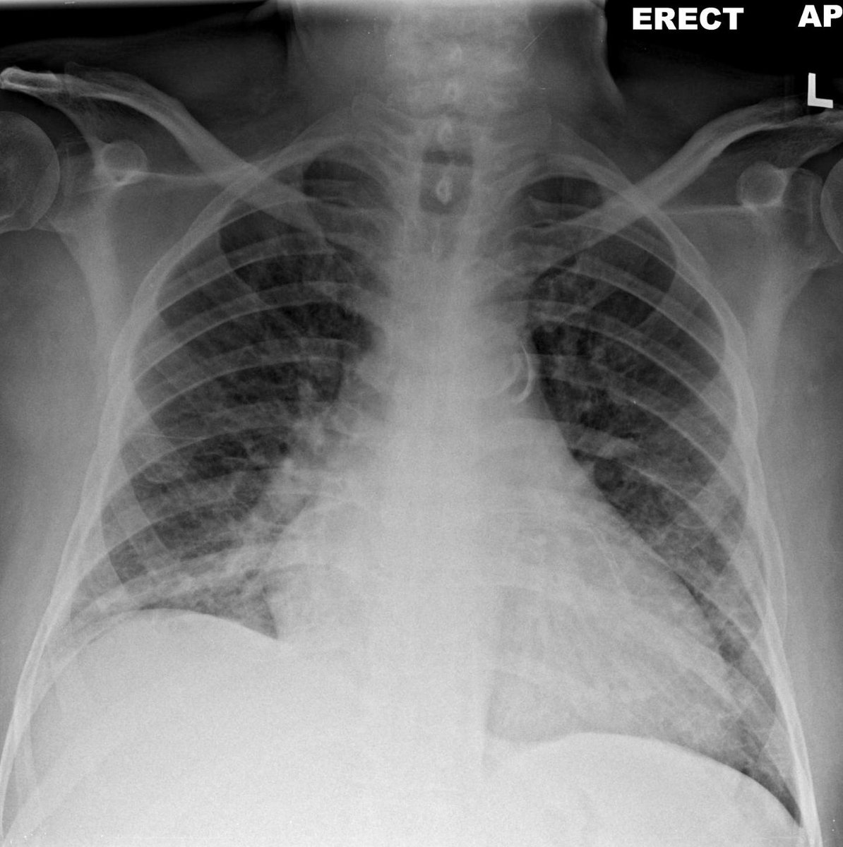 It's time for the weekly radiology image challenge! Case study: A 59-year-old man is experiencing breathlessness at rest. What is the most likely cause for these appearances? Head to the ERS Facebook to see the multiple choice answers & comment yours: facebook.com/EuropeanRespir…