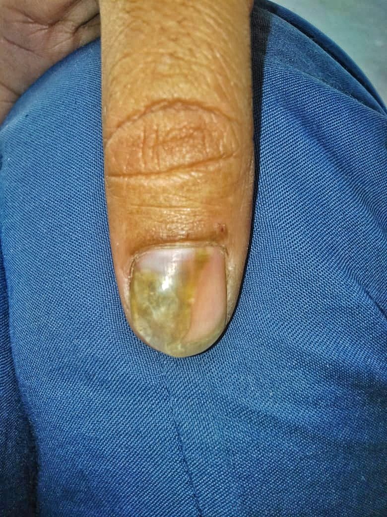 📙𝘾𝙇𝙄𝙉𝙄𝘾𝘼𝙇 𝙌𝙐𝙄𝙕:-

📝A 25yr old female p/w yellowish discoloration of nails & is diagnosed as a case of #Onychomycosis.

Drug of choice 🤔❓

A) Augmentin 
B) Terbinafine 
C) Doxycycline 
D) Metronidazole 

#medx
#medEd
#MedTwitter