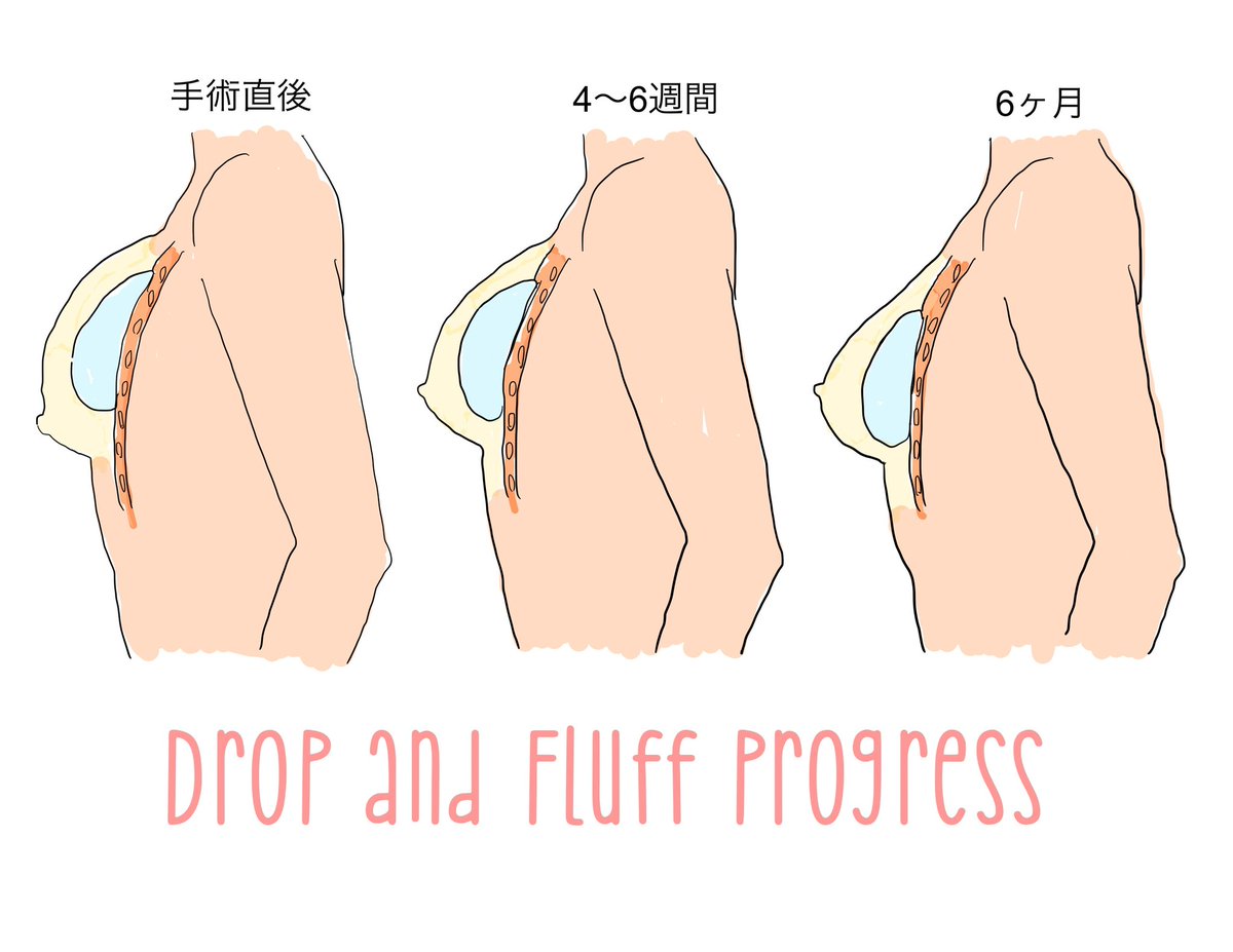 drop_and_fluff's tweet photo. シリコンを挿入すると🥧に高さやボリュームが出るまで長い期間が掛かります

私も最初の数週間は🥧が思ったより高く締まって見え、思ったより��さいし形が悪く見えました

でも皮膚や筋肉が緩み始めシリコンが組織で圧迫されなくなるとより豊満に見えるようになるはずです

だから術後に病まないでね😊 https://t.co/XDNYUg4ynC