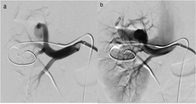 Renal arteriovenous fistula is a rare vascular malformation that can cause hemorrhage, hypokalaemic hypertension, heart failure + hematuria Here, balloon assisted coil embolization w/simultaneous transvenous + transarterial approach is described: cvirendovasc.springeropen.com/articles/10.11… #IRad