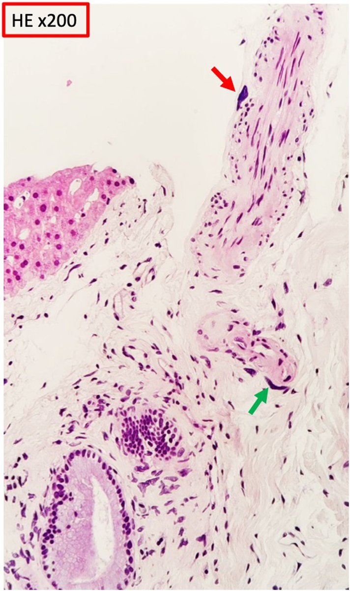 Nefritis intersticial cariomegálica. revistanefrologia.com/es-nefritis-in…