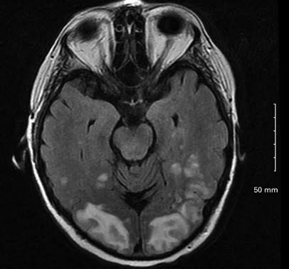 27 year old pregnant patient with eclampsia presented with altered mental status, seizures and vision loss. What's your diagnosis!! #MedEd #MedX