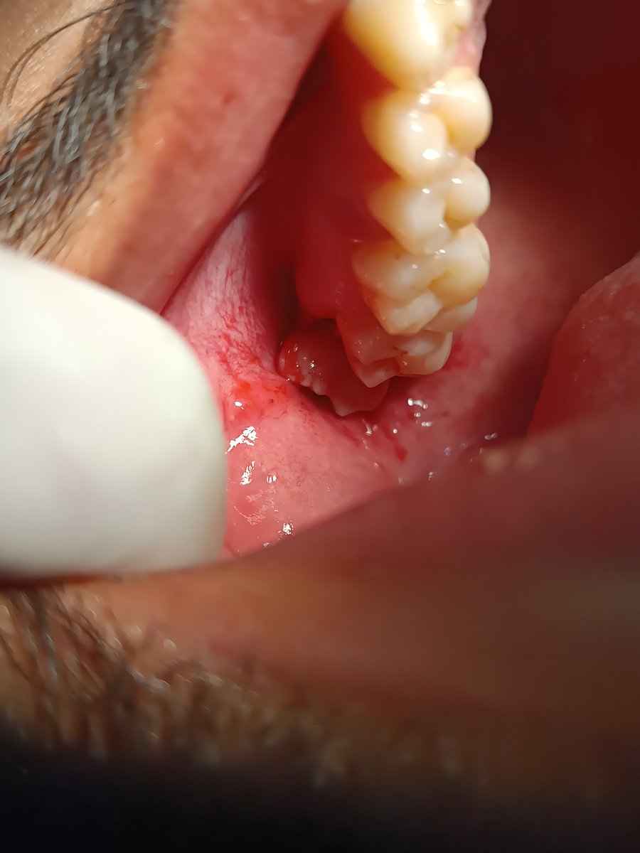 dentist_speaks's tweet photo. When direction is wrong, get Extracted... #ThirdMolar https://t.co/zOzbl3sKr0