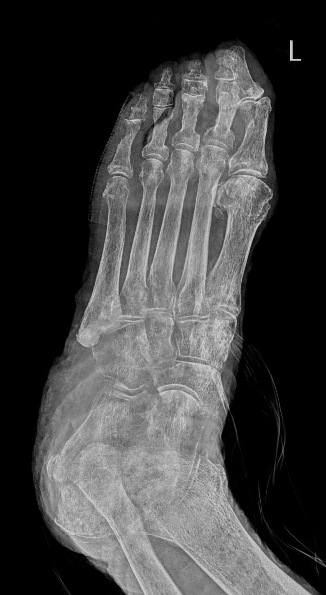 23/4/2024. 🔴 93 yo female, foot #XRAY reveals a bunch of findings. Reason for performing: malleolar pressure ulcers. 🦶 Describe the findings. What´s your diagnosis? 1⃣ Diabetic foot? 2⃣ Charcot? 3⃣ ...? Help me please. Stay tunned and let´s discuss. #MSK #traumatweeter