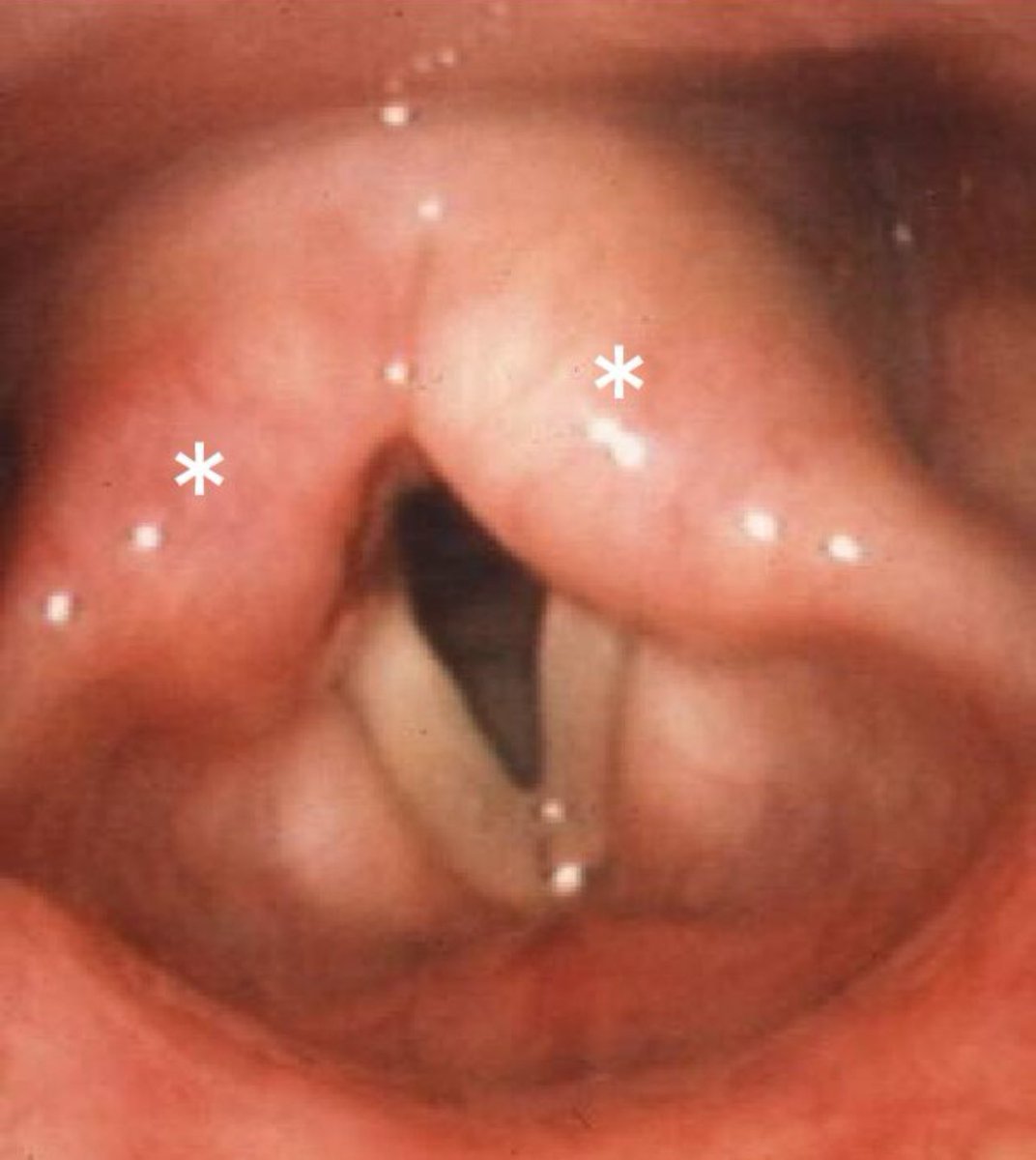 Laryngeal edema in a patient of #anaphylaxis!

#MedX
#MedTwitter
#NEETPG2024

What are other causes of laryngeal edema?