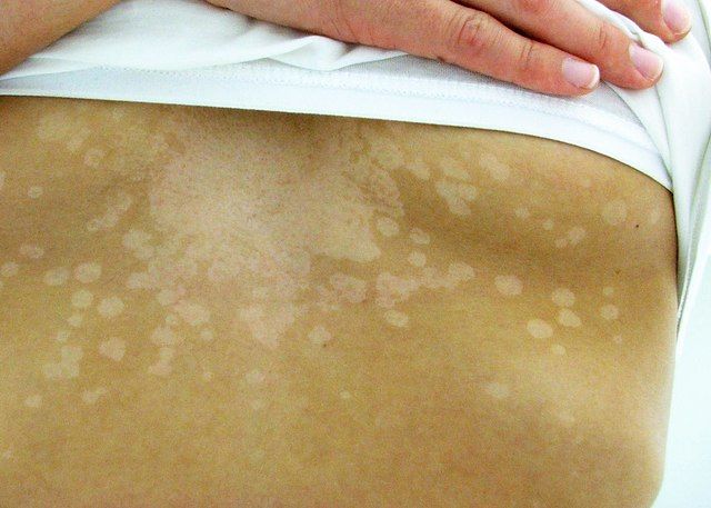 Pityriasis Versicolor is due to the overgrowth of fungus on your skin. Deal with it for good: - Smear activated charcoal on the skin before taking a bath - Then use coconut oil as your skin jelly - Fix your diet. Antifungal creams won't help you. #BetterTogether