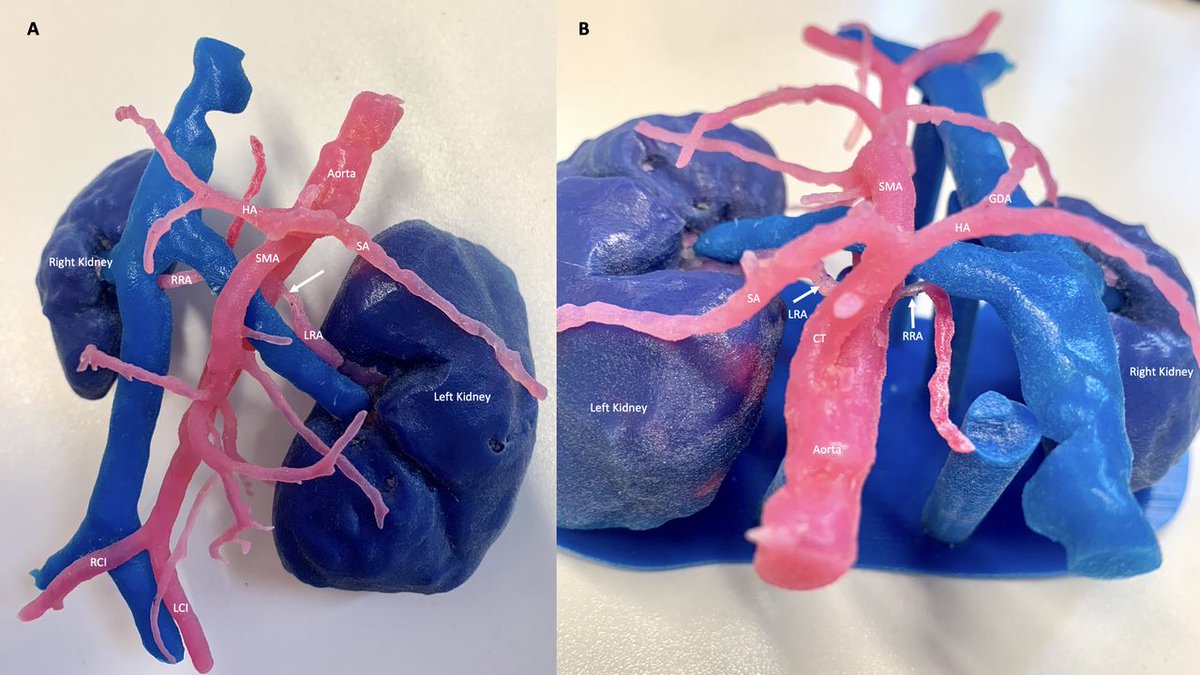 ADC_BMJ's tweet photo. What can 3D printing do for children with complex vasculature?

Potential to improve surgical safety, decision-making as well as patient understanding of procedure to be undertaken

@AliciaPaessler @kish_minhas @Premal__Patel @DrSamRay @dr_JelaS
https://t.co/bE1NKT1gTL https://t.co/LsGKEz0irJ