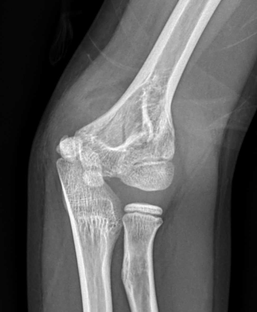 Elbow pain after fall on an outstretched hand. Diagnosis? What radiological signs do you find to support your diagnosis? #FOAMed #MedEd