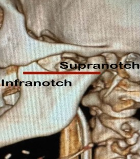 Members and invitees of the International Head and Neck Scientific Group (IHNSG.com) publish the review 'Primary Management of Operable Locally Advanced Oral Cavity #SquamousCellCarcinoma: Current Concepts and Strategies': link.springer.com/article/10.100… #headandneckcancer