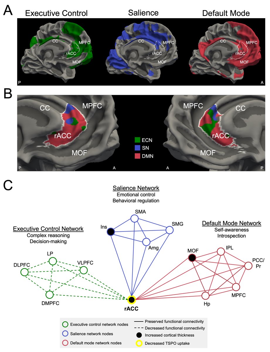 ComaRecoveryLab's tweet photo. In 30 active-duty US Special Operations Forces, higher blast exposure was associated with alterations in brain structure, function &amp; neuroimmune markers: https://t.co/lA3rqmi8MX

Imaging findings converged at rostral anterior cingulate cortex, which modulates cognition &amp; emotion. https://t.co/4s5apreSEV