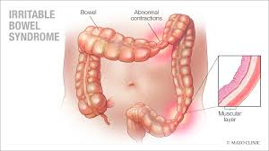 Irritable Bowel Syndrome: Causes, Symptoms, and Treatment Options

maishaonline.in/irritable-bowe…

#IrritableBowelSyndrome #ibs #Diet #fibre #fiber #HighFiberDiet #FOD #FODMAPDiet #diarrhea #spasm #Health #healthcare #HealthTips #HealthyEating