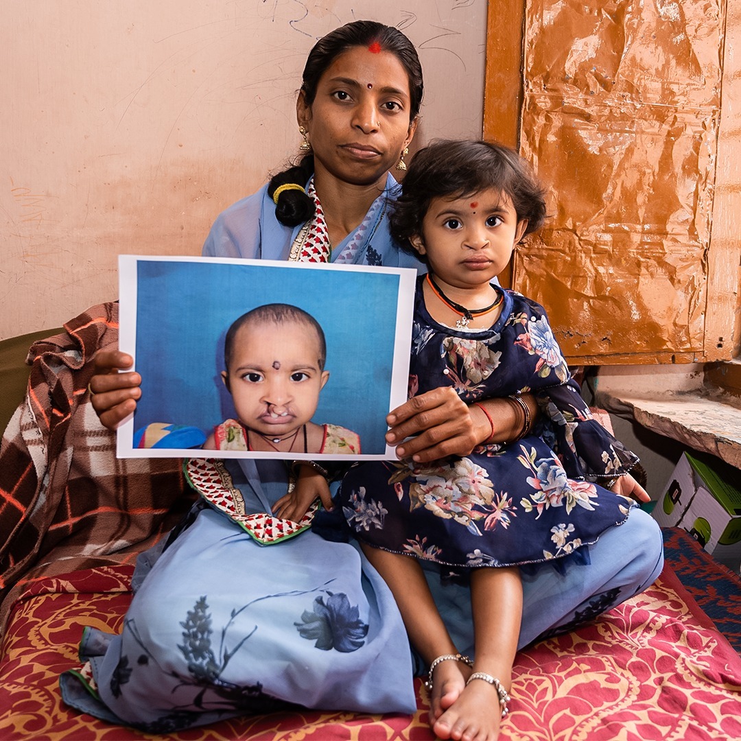 Say hi to Riya! 🇮🇳 Thanks to your generous support, we were able to assist Riya and her family in navigating their cleft journey with our local partner, GSR Hospital.