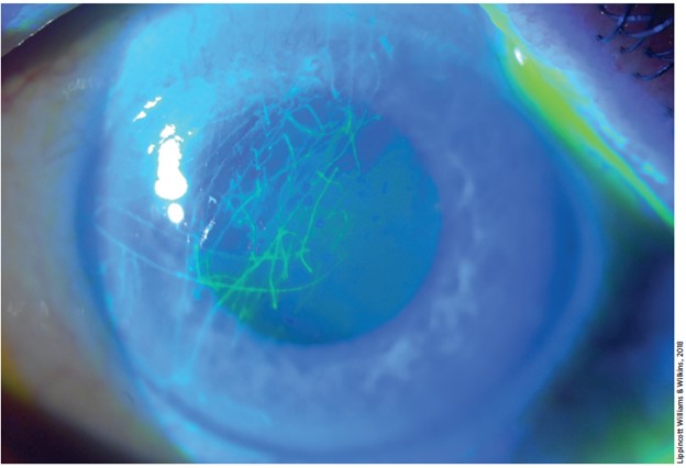 Managing corneal abrasion pain is a delicate balancing act between providing immediate relief and protecting long-term health. @Rick_Pescatore says topical anesthetics can be safely given, but patient selection & education are crucial. tinyurl.com/yn9ydhyb #FOAMed