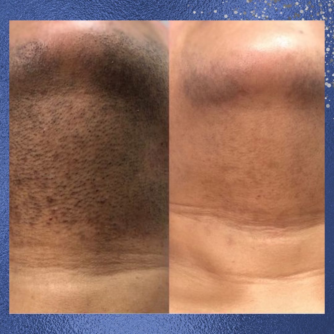 We offer laser hair removal that's both efficient and gentle on your skin. Say goodbye to unwanted hair and hello to smooth, carefree skin. Book your appointment today! #LaserHairRemoval
bronxivtherapy.com/laser-hair-rem…