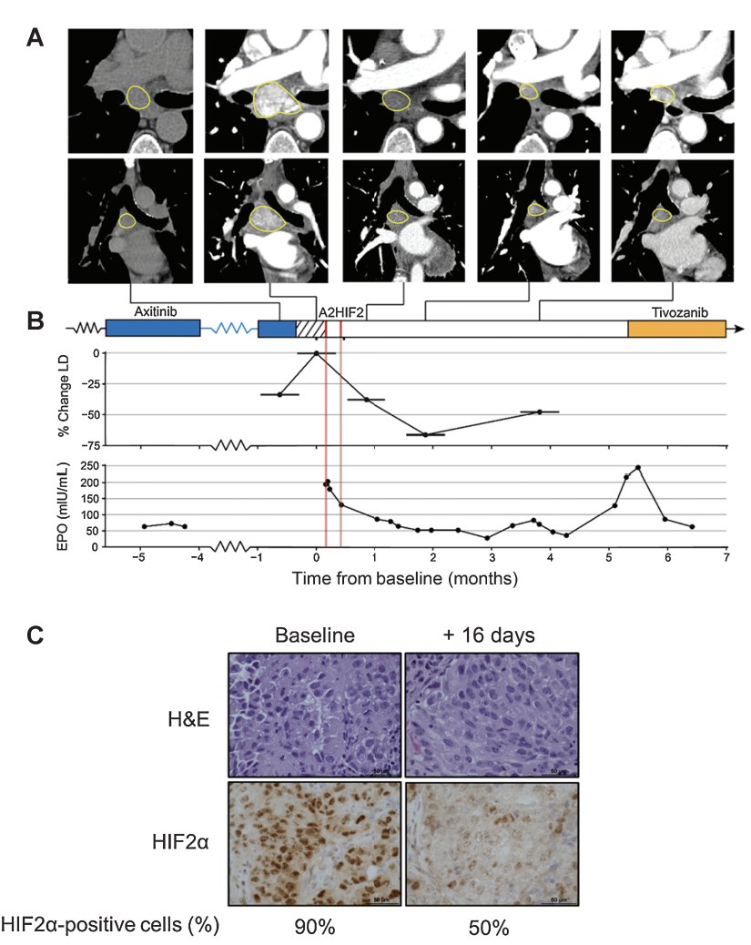 Congratulations to the team including Nizar @MDAndersonNews @brian_rini on first #siRNA #RCC phase 1 bit.ly/AROHIF2trial with @ArrowheadPharma #HIF2 siRNA building upon bit.ly/siHIF2RCCpre (PMID36190432) opening new field.