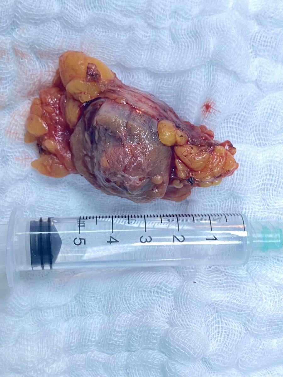 DR_HIG07's tweet photo. 🔹lap Lt partial nephrectomy
🔹I.T 26 minutes
استئصال جزئي لورم في الكلية بالمنظار الجراحي فقط بأربع جروح كل جرح أقل من ١ سم
Fore more
https://t.co/7bhKkMa2wi
#kidneycancer
#uroLap
#renal_mass
#urology
#cancer
#onology
#UroSoMe
@saudiurological
@saudiEndoUro
#Urological https://t.co/AgZseRQLoO