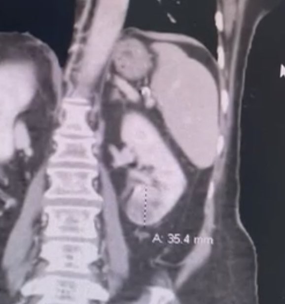 DR_HIG07's tweet photo. 🔹lap Lt partial nephrectomy
🔹I.T 26 minutes
استئصال جزئي لورم في الكلية بالمنظار الجراحي فقط بأربع جروح كل جرح أقل من ١ سم
Fore more
https://t.co/7bhKkMa2wi
#kidneycancer
#uroLap
#renal_mass
#urology
#cancer
#onology
#UroSoMe
@saudiurological
@saudiEndoUro
#Urological https://t.co/AgZseRQLoO